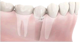 Dental implant along with natural teeth