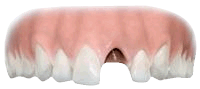 Replacing a missing tooth with an implant