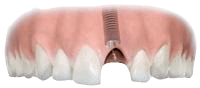 Installing a dental implant