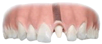 Adding an abutment to a dental implant