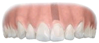 Implant with natural-looking tooth