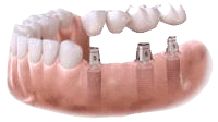 Implants ready for abutments