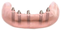 Foundation for dental implant bridge