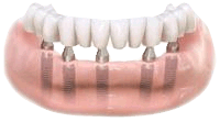Bridge attaches to abutments on dental implants