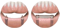Overdentures attach to ball abutments or small bar abutments