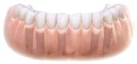 Natural looking teeth with implants
